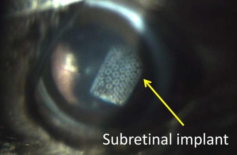 Subretinal photodiode retinal prosthesis is subretinally implanted in rat's eye (photo credit: PALANKER LAB)