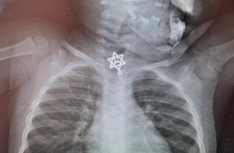 Star of David with “Life” inside threatens life of toddler when swallowed (photo credit: COURTESY KAPLAN MEDICAL CENTER)