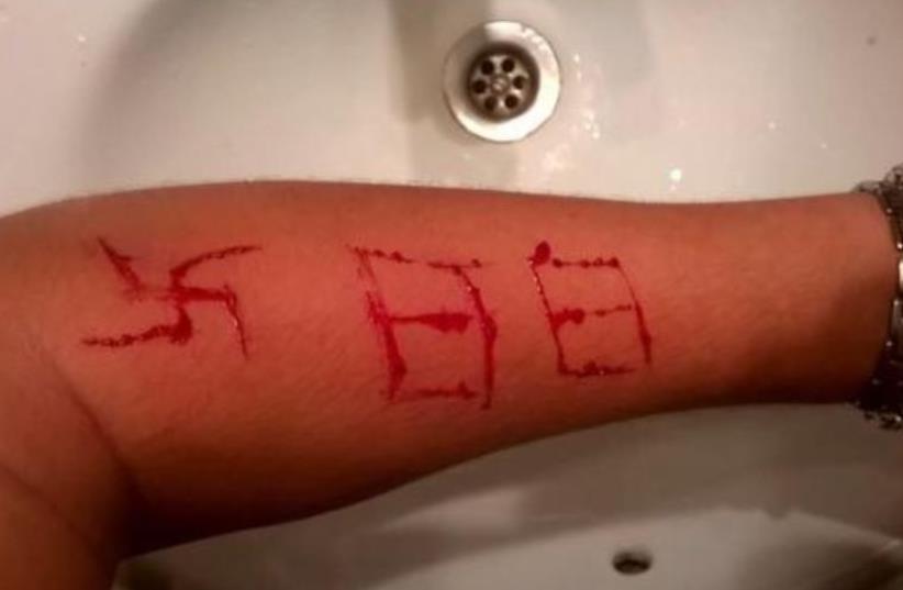 Neo-Nazis in Bilbao , Spain carved a swastika and 88 into this teen's arm with a razor blade (photo credit: TWITTER)