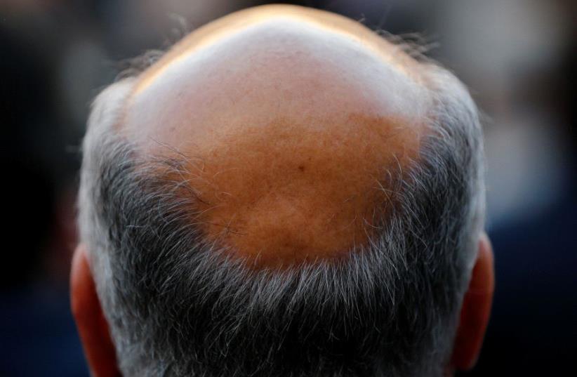 A man with baldness is seen in Seville, southern Spain (photo credit: REUTERS)