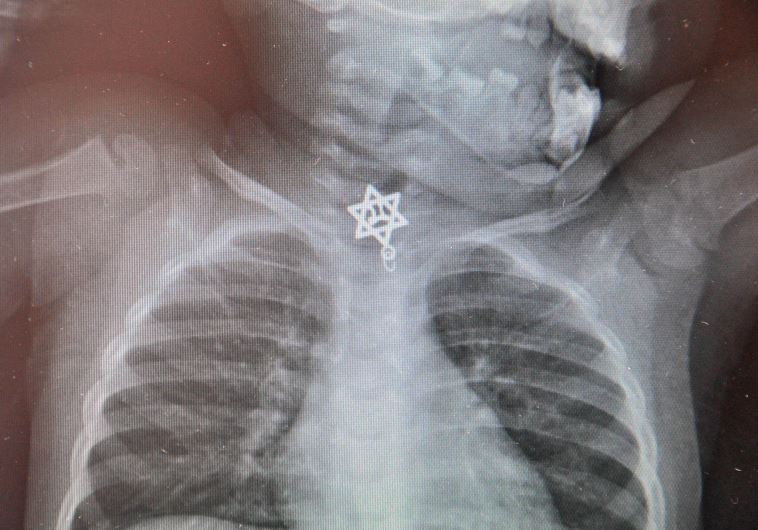 Star of David with “Life” inside threatens life of toddler when swallowed (credit: COURTESY KAPLAN MEDICAL CENTER)