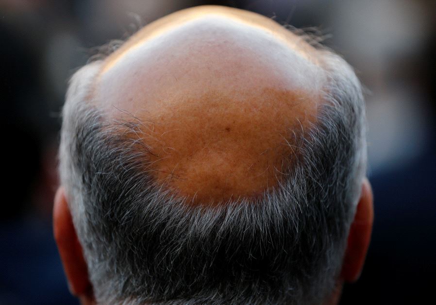 A man with baldness is seen in Seville, southern Spain (credit: REUTERS)